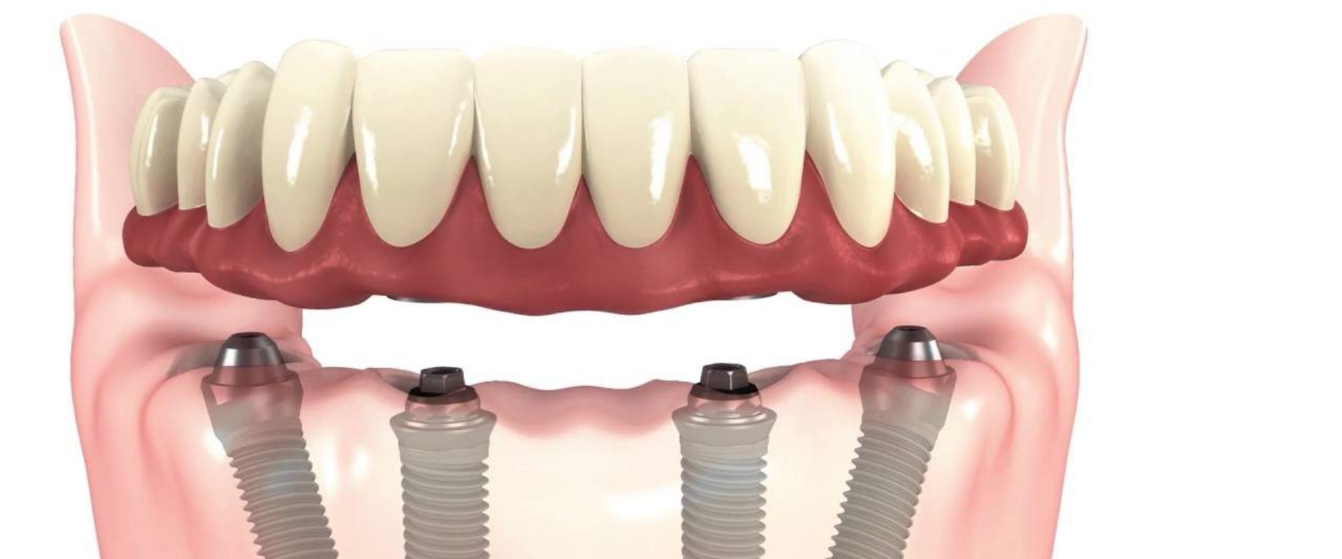 Understanding the 4 at the Dentist: What Do Those Numbers Really Mean?