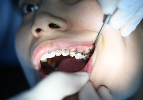 Why Regular Dental Checkups are Essential for Optimal Oral Health