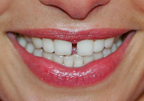 The Consequences of Avoiding the Dentist for 10 Years